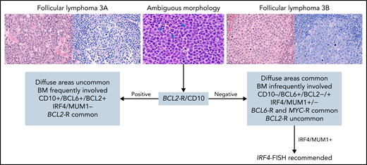 Suggested diagnostic studies in FL grade 3. Upper left: Cells from FL grade 3A are shown with hematoxylin and eosin (H&E) and Giemsa stains. Note the admixture of centrocytes and centroblasts (>15 per high power field) highlighted in the Giemsa stain. Upper right: Cells from FL grade 3B are shown with H&E and Giemsa stains. The follicles are composed of sheets of centroblasts with open chromatin, several nucleoli, and abundant basophilic cytoplasm highlighted with the Giemsa stain. Upper middle: Cells from FL with ambiguous morphology are shown. They are medium-size with open chromatin but inconspicuous nucleoli unlike centroblasts (arrows) and without the cytologic features of centrocytes. With ambiguous morphology (blue arrow), the presence of BCL2 rearrangement and/or CD10 expression favors the diagnosis of FL grade 3A; if both are absent, a diagnosis of FL grade 3B is favored. In patients who have FL grade 3B with IRF4/MUM1 expression, IRF4-FISH analysis is recommended to exclude the diagnosis of large B-cell lymphoma with IRF4 rearrangement. Original magnification ×400. BM, bone marrow.