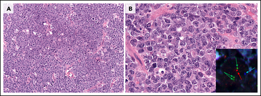 Large B-cell lymphoma with 11q aberration. (A) Low power view of large-cell morphology, abundant mitoses, and the characteristic starry-sky pattern with abundant macrophages with coarse apoptotic bodies (original magnification ×200; H&E stain). (B) Higher magnification reveals the large centroblastic morphology of the tumor cells (original magnification ×400; H&E stain). Inset: FISH analysis demonstrated the typical 11q alterations (blue, centromere; red, 11q24 loss; green, 11q23 gain; ×1000). The cytology of the cells might be medium-size to large-size cells. The morphology and mutational profile justify the change in the name of this entity (previously, Burkitt-like lymphoma with 11q aberration).