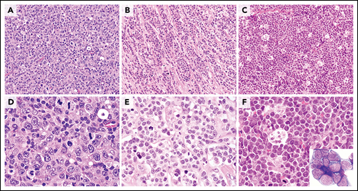 Morphologic characterization of highly proliferative B-cell lymphomas. (A-B) This DLBCL, NOS has many mitotic figures, but many of the neoplastic cells are typical large transformed cells that do not resemble either BL cells or B lymphoblasts. Chromosomal analysis showed a complex karyotype, but there was no evidence of MYC or BCL2 rearrangement. (C-D) This HGBCL, NOS is composed of relatively small blastoid-appearing cells with many mitotic figures, reminiscent of a B-lymphoblastic leukemia/lymphoma. TdT was negative. It had a complex karyotype that included t(14;18)(q32;q21) and i(17)(q10). (E-F) This HGBCL with MYC and BCL6 rearrangements (without evidence of IGH::BCL2) resembles BL with intermediate-size transformed cells and a starry-sky appearance with scattered tingible body macrophages. The cytospin (inset) demonstrated cytoplasmic vacuoles. Unlike classic BL, it was BCL2 protein positive and had only equivocal CD10 positivity. All panels were stained with H&E except for the inset stained with Wright-Giemsa stain. Original magnification ×400 for panels A, C, and E; original magnification ×1000 for panels B, D, and F and inset.
