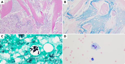 A 61-year-old homeless woman with untreated HIV infection and severe malnutrition was admitted to the hospital following a fall. On admission, she was found to have severe pancytopenia and CD4 count of 28 cells per µL, for which bone marrow biopsy was performed. Biopsy revealed bone marrow replacement by a gelatinous material, which stained positive with Alcian blue (panel A; 10× objective, ×100 magnification; hematoxylin and eosin stain; panel B; 10× objective, ×100 magnification; Alcian blue stain). In addition, Grocott methenamine silver (GMS) staining revealed multiple fungal organisms contained within vacuoles in the bone marrow (panel C; 100× objective, ×1000 magnification; GMS stain). Concomitantly, the patient was tested positive for Histoplasma antigen, supporting the special stain findings. Immunostaining for human herpesvirus 8 returned negative. Bone marrow aspirate revealed polytypic plasma cells and hemophagocytosis (panel D; 40× objective, ×400 magnification; hematoxylin and eosin stain), which could be related to either HIV infection or fungal infection.
