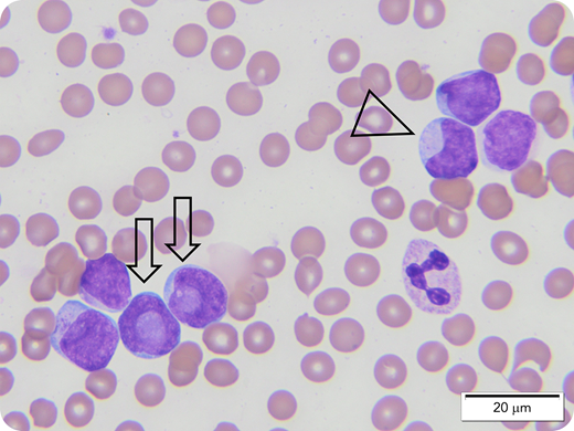 A 4-year-old child presented with fever and was found to have leukocytosis, anemia, and thrombocytopenia (white blood cells = 136 200/µL; hemoglobin = 8.7 g/dL; platelets = 108 000/µL). Examination of a peripheral blood smear showed blasts constituting 88% of cells. The blasts were mostly medium sized with scant to moderate light-blue cytoplasm; round, oval to irregular nuclei; smooth chromatin; and conspicuous nucleoli. Most blasts showed cytoplasmic red granules, but no Auer rods were seen. The preliminary impression was acute myeloid leukemia (AML). Immunophenotyping showed blasts expressing myeloperoxidase, CD33, CD56 (partial), CD117 (partial), CD11c with negative HLA: Dr., CD34, and CD15. This immunophenotype raised the possibility of acute promyelocytic leukemia (APL). Molecular study to exclude t(15;17) was initiated, and staining of additional peripheral blood smears using a manual method (for better morphologic details) was requested. Review of these slides demonstrated blasts with characteristic cup-shaped nuclei (×100 objective), typical of AML with a normal karyotype, positive FLT-3, and NPM1 mutation. Based on the classic morphologic findings, the patient was started on non-APL treatment. Cytogenetic findings became available later, confirming a normal karyotype, positive FLT-3 internal tandem duplication, and NPM1 mutation.
