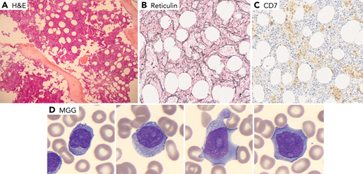 A 68-year-old patient was admitted for increased splenomegaly after 6 months of treatment with ruxolitinib for primary myelofibrosis (PMF). No JAK2 V617F/exon12- MPL- CAL-R or other mutations were detected in next-generation sequencing analysis (77 genes panel). Bone marrow biopsy showed increased cellularity (panel A, original magnification ×100) with grade 2 myelofibrosis based on reticulin stain (panel B, original magnification ×200). There was no improvement after addition of hydroxyurea. The blood cell count on admission showed mild neutropenia and thrombocytopenia, a discrete hyperlymphocytosis (4-5 × 109/L) with presence of abnormal lymphocytes on the blood film, some with cytoplasmic granules, others with a blastic appearance with nucleoli (panel D, original magnification ×1000). The flow cytometry analysis showed 85% natural killer (NK) cells, CD7+/sCD3−/CD2+/CD5−/CD4−/CD8−/CD56+/CD16+ low/CD57−. The diagnosis of aggressive NK cell leukemia was made. Histological review of the initial bone marrow biopsy showed interstitial and sinusoidal infiltration by NK cells (panel C, CD7 stain, original magnification ×200). Karyotyping of peripheral blood cells showed a hypodiploid complex karyotype. The disease progressed rapidly despite 2 lines of treatment.