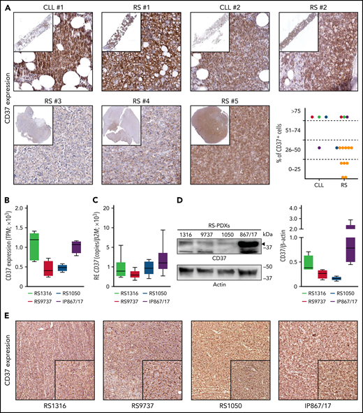 CD37 is expressed by Richter syndrome primary samples and patient-derived xenograft models. CD37 expression on primary RS samples was checked by immunohistochemistry performed on bone marrow or lymph node biopsy specimens from patients with RS (yellow dots) or paired CLL-RS samples (A; red-green-dark blue-purple dots). Representative staining of 2 paired CLL-RS and 3 RS samples. Original magnification, ×200; inset ×6. CD37 expression was checked, both at the transcript and protein levels, in our 4 RS-PDX models (RS1316, RS9737, RS1050, and IP867/17) by RNA sequencing (B; n = 4 per model; box and whiskers, minimum to maximum representation), quantitative real-time PCR (C; n = 8 per model; box and whiskers, minimum to maximum representation), western blot analysis (D; n = 4 per model; box and whiskers, minimum to maximum representation) and immunohistochemistry staining on slides of formalin-fixed and paraffin-embedded, RS-PDX–derived tumor masses (E). In western blot analyses, actin was used as a loading control. RE, relative expression; TPM, transcript per million.