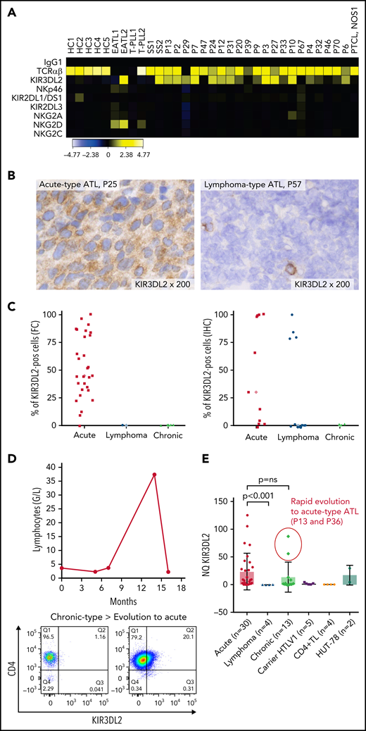 The NK receptor KIR3DL2 is expressed by tumor cells in patients with acute-type ATL. (A) Heat map showing NK receptor expression (defined using FC) in PBMCs sampled from 5 healthy controls (HCs), 2 patients with enteropathy-associated T-cell lymphoma (EATL), 2 patients with T-cell prolymphocytic leukemia (T-LPL), 2 patients with Sezary syndrome (SS), 1 patient with peripheral T-cell lymphoma, not otherwise specified (PTCL-NOS), and 21 patients with ATL. The heat map represents the ratio of fluorescence intensity, as regards the isotypic control (IgG1), expressed as an arbitrary unit, to scale the color code of the heat map using the cytobank software (https://www.cytobank.org). High protein expressions are shown in yellow, and negative protein expressions are shown in black. KIR3DL2 was the only NKR expressed on ATL tumor cells among those studied. (B) IHC assessment of KIR3DL2 protein expression on representative lymph node biopsy specimens (original magnification, ×200), showing that a patient with acute-type ATL (P25) expressed KIR3DL2, whereas a patient with lymphoma-type ATL (P57) did not. (C) Percentage of KIR3DL2+ cells among tumor cells in patients with ATL by FC or IHC, according to the ATL subtype (acute, lymphoma, and chronic type). (D) Example of a patient (P18) with KIR3DL2− chronic-type ATL, which became KIR3DL2+ at the time of the transformation into an acute-type ATL. After 12 months of evolution, the patient presented with lymphocytosis (38.3 × 103 μL) with 96% abnormal KIR3DL2+ lymphocytes, high levels of lactate dehydrogenase, and lymph node and central nervous system involvement, leading to a diagnosis of an acute-type ATL. (E) KIR3DL2 mRNA expression (assessed by qRT-PCR) in PBMCs from 48 patients with ATL, 5 HTLV-1 carriers, CD4+ T lymphocytes from 4 healthy donors, and Hut 78 cells (2-sided Mann-Whitney nonparametric test). Two patients (P13 and P36) with high KIR3DL2 mRNA expression levels were diagnosed as having chronic-type ATL at the time of mRNA analysis; subsequently, the diseased transformed into KIR3DL2+ acute-type ATL.