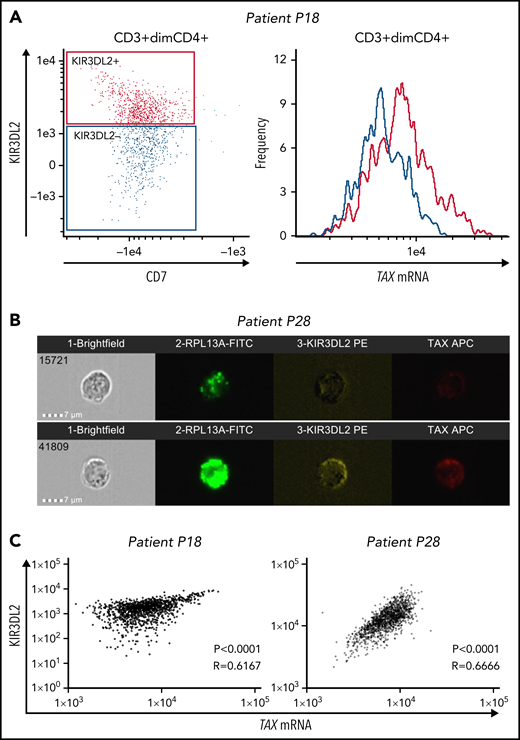 TAX mRNA and KIR3DL2 protein expressions correlate in primary ATL tumor cells. Primary ATL cells from 3 patients were cultured in vitro for 12 to 15 hours before the PrimeFlow RNA assay. For 2 of the patients (P18 and P28), TAX mRNA expression and KIR3DL2 cell surface protein expression were quantified with the ImageStream X Mark II imaging flow cytometer. (A) The expression of TAX mRNA was higher in tumor cells expressing KIR3DL2 (red) than in those not expressing it (blue). (B) Two illustrative images of ImageStream experiments. Cells were probed for the positive control RPL13A, KIR3DL2, and TAX mRNA expression and run on the ImageStream. Bar represents 7 μm. Tumor cells coexpress KIR3DL2 and TAX mRNA with a cytoplasmic localization or express neither KIR3DL2 nor TAX mRNA. (C) Correlation between TAX mRNA expression and KIR3DL2 cell surface protein expression quantified with the ImageStream for 2 of the patients (P18 and P28). The P value and Spearman correlation coefficient are indicated.
