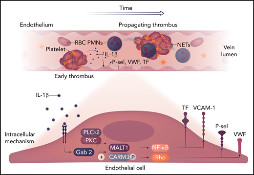The early venous thrombotic events are shown, with polymorphonuclear neutrophils (PMNs) as likely sources of IL-1β. This stimulates the endothelial Gab2 pathway, which, via MALT1 and CARAMA3 (CARM3), activates NF-κB and Rho signaling, with tissue factor (TF) and von Willebrand factor (VWF) release, as well as P-selectin (P-sel) and VCAM-1 expression. These factors act to amplify the thromboinflammatory process. NET, neutrophil extracellular trap; PKC, protein kinase C; PLC, phospholipase C; RBC, red blood cell. Professional illustration by Somersault18:24.