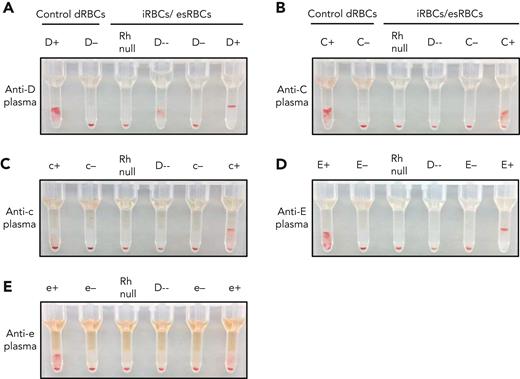 Detection of Rh antibodies in patient plasma using iRBCs and gel column agglutination. (A-E) Plasma containing (A) anti-D, (B) anti-C, (C) anti-c, (D) anti-E, and (E) anti-e were tested against a panel of control dRBCs and ficin-treated iRBCs or esRBCs. Each assay included control dRBCs expressing or lacking the corresponding Rh antigen (left) along with Rh null and D-- iRBCs, and iRBCs/esRBCs negative or positive for the corresponding Rh antigen (right). Agglutination prevents cells from traveling through the gel matrix to the bottom of each column upon centrifugation and indicates the presence of antibody in the plasma sample.