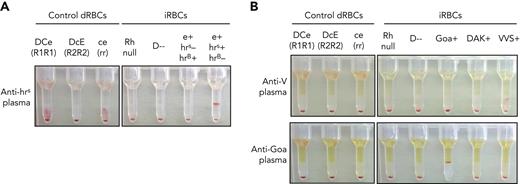 iRBCs identify antibodies against high-prevalence or low-prevalence Rh antigens in patient plasma. (A-B) Patient plasma containing antibody against (A) the high-prevalence antigen hrS or (B) low-prevalence antigens V or Goa were tested against a panel of control dRBCs and ficin-treated iRBCs. Each assay included the 3 control dRBCs routinely used for antibody screening: DCe (R1R1), DcE (R2R2), and ce (rr) phenotypes (left). In panel A, iRBCs that were Rh null, D--, e+ hrS− hrB+, and e+ hrS+ hrB− were selected to show hrS specificity (right). In panel B, patient plasma was tested against iRBCs that were Rh null, D--, or expressing low-prevalence Goa, DAK, or VVS antigens. Agglutination of cells prevents them from traveling through the gel matrix to the bottom of each column upon centrifugation and indicates the presence of antibody in the plasma sample.