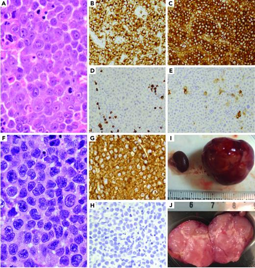 ALK-positive large B-cell lymphoma patient-derived xenografts. (A-E) ALK-positive large B-cell lymphoma morphology shows sheets of large neoplastic lymphoid cells with plasmablastic morphology (A), including moderate to abundant cytoplasm and round to irregular nuclei with prominent nucleoli. The neoplastic cells are positive ALK1 (B) and IgA (C), and negative for CD20 (D) and CD30 (E). (F-J) A PDX model of the ALK-positive large B-cell tumor was generated by implanting a tumor fragment underneath the kidney capsule, which generated a tumor mass after 6 to 8 weeks. The morphology of the PDX model (F) was identical to that of the patient's tumor, with strong ALK1 expression (G) and negative for CD20 (H). (I) PDX tumor replacing the implanted left kidney of mouse (right) and uninvolved right kidney on left (millimeters). (J) PDX bivalved showing tan, soft-cut surface of tumor (centimeters).