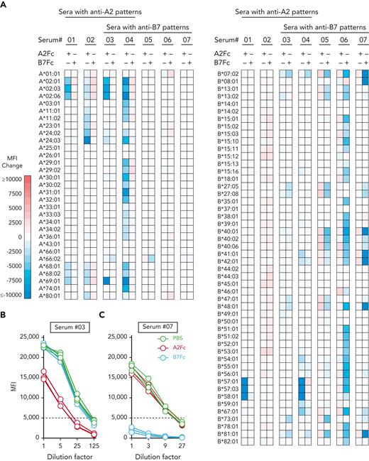 Neutralization of cognate antibodies by HLA-Fc in clinical samples. (A) Changes in anti-A2 and -B7 reactivities in sera treated with A2Fc or B7Fc relative to PBS treatment. Clinical samples reactive to A2 (sera 01-02), or B7 (sera 05-07), or both (sera 03-04) were incubated with PBS, A2Fc, or B7Fc before testing by the single-antigen bead assay. The changes in mean fluorescence intensity (MFI) values after A2Fc or B7Fc treatment compared to PBS treatment are represented as a heatmap for each bead. Each row represents a bead specificity; the left and right panels show HLA-A- and HLA-B-specific beads, respectively. Red and blue hues indicate increased and decreased MFI, respectively. (B-C) Neutralization of anti-A2 and anti-B7 reactivities in titrated serum samples #03 (B) and #07 (C) by cognate HLA-Fc. Serial 1:5 dilutions were performed on the sera before incubation with PBS (green), A2Fc (red), or B7Fc (blue), followed by the single-antigen bead assay. The A2-specific reactivity in (B) was represented by MFI values from A∗02:01, A∗02:03, and A∗02:06 beads; The B7-specific reactivity in (C) was represented by B∗07:02, B∗42:01, and B∗81:01 beads (serum #07 is cross-reactive to these 3 antigens). Broken lines at 5000 MFI indicate the threshold associated with positive lymphocyte crossmatching.