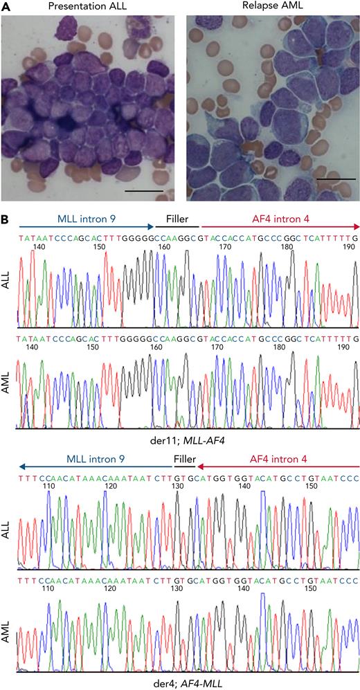 Characterization of MLL/AF4 lineage-switched cases. (A) Morphological change from lymphoblastic leukemia (left) to acute monoblastic/monocytic leukemia (right) in patient LS01. Bar represents 20 μm. (B) Sanger sequencing of MLL/AF4 and reciprocal AF4/MLL fusions in LS01 presentation ALL (top) and relapsed AML (bottom) identifies a common breakpoint with identical filler sequences in the ALL and AML samples.