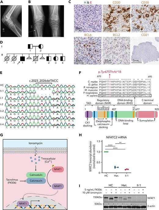 Clinical phenotype of a patient with NFAT1 deficiency, joint contractures, and B-cell malignancy. (A) Radiograph demonstrating the extent to which knees could be straightened, documenting the fixed flexion deformity. (B) Osteochondroma (arrow) on the anterior aspect of the right proximal fibula. (C) Hematoxylin and eosin (H&E) stain and CD20, CD21, CD30, BCL2, and BCL6 immunostain of a patient lymph node biopsy. Scale bars for H&E, CD20, CD30, BCL6, and BCL2 are 50 μm, and that for CD21 is 3 mm. (D) Family pedigree. Half-filled symbols represent heterozygous unaffected individuals, filled symbols represent homozygous affected individual; arrow represent proband; question marks represent ungenotyped. (E) Sanger sequencing of DNA extracted from whole blood of the patient, family members, and a healthy control. Site of 4–base-pair deletion is indicated. (F) Schematic illustrating the protein domains of NFAT1. Location of variant is shown in red. Affected region was aligned to other species. Asterisks indicate full conservation. (G) Schematic illustrating ionomycin-induced activation of calcineurin and NFAT1. (H) NFATC2 transcript abundance relative to β-actin (ACTB) in the patient (II-1), a heterozygous control (II-2), and a healthy control (HC) determined by quantitative PCR. Red diamonds, II-1; blue circles, II-2; green circles, HC. ∗∗P < .01, ∗∗∗∗P< .0001, one-way analysis of variance and Tukey’s post hoc test. (I) Immunoblot of patient (II-1), heterozygous control (II-2), and control-derived LCLs using an N-terminal NFAT1 antibody before and after 10 minutes of ionomycin stimulation with or without FK506 treatment (n = 3).