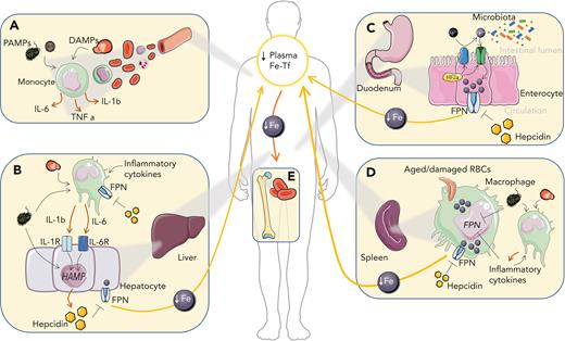 Iron-related mechanisms contributing to the generation of AI. (A) In circulation, pathogen-associated molecular patterns (PAMPs) and damage-associated molecular patterns (DAMPs) activate myeloid cells leading to the production of proinflammatory cytokines. (B) Hepatocyte stimulation with proinflammatory cytokines, especially IL-6 and IL-1β, and PAMPs stimulates the expression of the liver iron hormone hepcidin, which promotes autocrine and paracrine iron retention due to the degradation of the iron exporter FPN. Kupffer cell stimulation with proinflammatory cytokines, PAMPs and DAMPs further feeds cytokine-mediated hepcidin upregulation in the liver. (C) Increased hepcidin levels in circulation block dietary iron import by degrading FPN. Local intestinal inflammation promotes HIF-2α (hypoxia-inducible factor 2α) stabilization and duodenal cytochrome b (DCYTB)/divalent iron transporter 1 (DMT1)–mediated iron absorption and may alter the composition of the intestinal microbiota. (D) In the spleen, where macrophages turn over large amounts of iron owing to the recycling of RBCs, iron accumulates in response to cytokines, hepcidin, PAMPs, and DAMPs, which decreases FPN-mediated iron export and affects additional pathways that cause iron retention. (E) Macrophage iron retention and decreased iron absorption reduce plasma iron levels and limit iron availability for erythroid progenitors, where iron is required for heme biosynthesis. As a consequence, anemia develops. Fe, iron; Fe-Tf, iron transferrin; TNF, tumor necrosis factor.