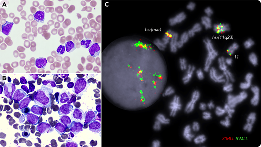 A 72-year-old female with a history of JAK2-mutated essential thrombocythemia presented with easy bruising and hematuria; white blood cell count of 33 × 109/L; monocyte count of 4.95 × 109/L; platelet count of 35 × 109/L; prothrombin time of 17.1 seconds; APTT, 71 seconds; fibrinogen level of 1.74 g/L; D-dimer of 80 000 µg/L FEU; indicative of disseminative intravascular coagulation (DIC). The blood film (panel A; May-Grünwald-Giemsa stain, 100× objective, original magnification ×1000) showed vacuolated blasts, monocytosis, dysplastic neutrophils, red cell fragments, and thrombocytopenia. Bone marrow smear (panel B; May-Grünwald-Giemsa stain, 100× objective, original magnification ×1000) showed large blasts and hypogranulated granulocytes; by flow cytometry, blasts (41%) were positive for CD34, CD33, CD15, CD38, and cMPO. Molecular karyotyping identified a complex genome with chromothrypsis within the 11q23/qter segment, resulting in amplification of many genes, including the MLL gene. Fluorescence in situ hybridization analysis detected MLL amplification and mapped it at the hrs (homogenously stained) regions (panel C; 100× objective, original magnification ×1000; DAPI staining). Next-generation sequencing identified TP53 p.Arg248Gln (VAF 98%), JAK2 p.Val617Phe (VAF 64%), and BCORL1 p.Pro482GlnfsTer16 (VAF 18%) variants. The patient was treated with daily blood products, venetoclax and azacytidine. She died 2 weeks later with refractory leukemia and persistent DIC.