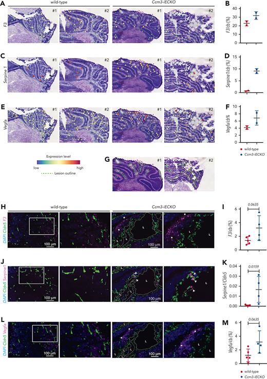 CCM pathology promotes the expression of genes and proteins related to the coagulation cascade and hypoxia in vivo. (A) Visium spatial transcriptomics illustrating the expression of F3 in wild-type and Ccm3-iECKO P8 cerebellum sections. (B) Quantification of F3 in the cerebellum (cb) of wild-type and Ccm3-iECKO mice. (C) Visium spatial transcriptomics illustrating the expression of Serpine1 in wild-type and Ccm3-iECKO cerebellums. (D) Quantification of Serpine1 in the cerebellum (cb) of wild-type and Ccm3-iECKO mice. (E) Visium spatial transcriptomics illustrating the expression of Vegfa in wild-type and Ccm3-iECKO cerebellums. (F) Quantification of Vegfa in the cerebellum (cb) of wild-type and Ccm3-iECKO mice. (G) Hematoxylin and eosin-stained Ccm3-iECKO P8 cerebellum sections with lesions outlined in green. (H) RNAscope images of representative wild-type (right panel) and Ccm3-iECKO (left panel) cerebellum sections; a region is highlighted with a white box and magnified to the right. Lesions are outlined in dotted white lines and regions of interest are marked with a white asterisk; 4′,6-diamidino-2-phenylindole(DAPI) (blue), Cldn5 (green), F3 (magenta). (I) Quantification of F3 in the cerebellum (cb) of wild-type and Ccm3-iECKO mice (P = .0635). (J) RNAscope images of representative wild-type (right panel) and Ccm3-iECKO (left panel) cerebellum sections. Lesions are outlined in dotted white lines; DAPI (blue), Cldn5 (green), Serpine1 (magenta). (K) Quantification of Serpine1+Cldn5+ endothelial cells in the cerebellum (cb) of wild-type and Ccm3-iECKO mice (P = .0159). (L) RNAscope images of representative wild-type (right panel) and Ccm3-iECKO (left panel) cerebellum sections; a region is highlighted with a white box and magnified to the right. Lesions are outlined in dotted white lines; DAPI (blue), Cldn5 (green), Vegfa (magenta). (M) Quantification of Vegfa in the cerebellum (cb) of wild-type and Ccm3-iECKO mice (P = .0635). (N) Primary human brain endothelial cells (HBECs) transduced with shRNA (scramble or CCM3) blotted and quantified (O) CCM3 (P = .0035), (P) TF (P = .3650), (Q) VEGF-A (P = .8346), and (R) PAI-1 (P = .0178). In the graphs N-R, n = 3 independent experiments. In graphs B, D, F, I, K, and M each data point represents 1 biological replicate (n = 2-8 mice per group), the bar indicates the mean of each group, and the error bars represent the standard deviation. For the RNAscope graphs, a Mann-Whitney U test was used to compare wild-type mice with Ccm3-iECKO mice. For the western blot quantifications, a t-test was used to compare shScramble with shCCM3 cells. The corresponding P values are indicated on each graph. L, lesion.