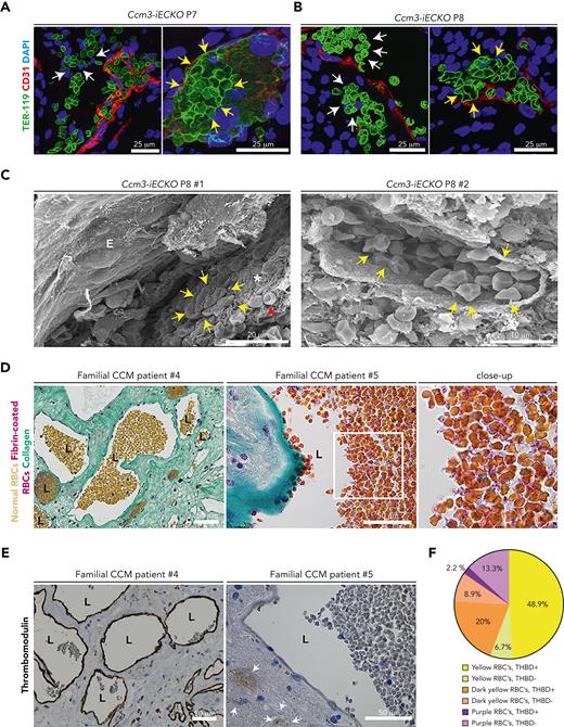 Vascular heterogeneity results in either microbleeds or polyhedrocytes at the vessel wall. (A) Confocal images of Ccm3-iECKO P7 (right) and (B) P8 (left) cerebellums illustrating microbleeds (white arrows) and polyhedral red blood cells (yellow arrows); DAPI (blue) TER-119 (green), and CD31 (red). (C) Scanning electron microscopy images of vessels in Ccm3-iECKO mice. In the right panel a clot near the vessel wall is seen with polyhedrocytes (yellow arrows), fibrin threads (asterisk), and regular red blood cells (red arrowhead). In the right panel, a vessel is seen with multiple polyhedrocytes. (D) Familial CCM patient biopsy stained for LENDRUM; normal red blood cells (yellow), fibrin-coated red blood cells (pink), and collagen IV (green). Different regions highlight the heterogeneity of red blood cells. In the left normal red blood cells are shown, and in the middle panel fibrin-coated red blood cells are highlighted. The region highlighted in a white box is magnified to the right. (E) Familial CCM patient biopsy stained for thrombomodulin. Patient #4 shows lesions with a high expression of thrombomodulin, and patient #5 shows a lesion with no thrombomodulin. White arrow shows hemosiderin, which is an indication of a previous hemorrhage. (F) Pie chart showing the quantification of the heterogeneous expression of thrombomodulin relative to red blood cell (RBC) composition. THBD, thrombomodulin; RBC, red blood cells.