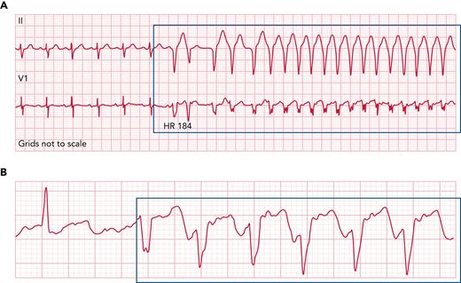 Representative ECG rhythm strips from patients with ventricular arrhythmias following acalabrutinib initiation. Representative ECG rhythm strip from a patient (A) with unexplained ventricular tachycardia episodes nearly 6 weeks after acalabrutinib initiation for chronic lymphocytic leukemia, as well as (B) from a patient with symptomatic premature ventricular contractions nearly 20 months after acalabrutinib initiation. Acalabrutinib dose was 100 mg twice daily, and symptoms included fatigue, palpitations, and shortness of breath. ECG, electrocardiogram; HR, heart rate.
