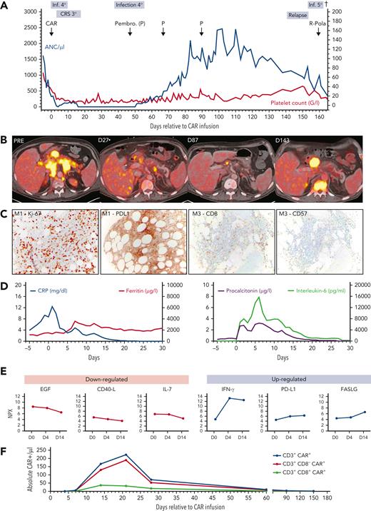 Clinical course of protracted cytopenia after CD19 CAR-T therapy. (A) Timeline of the absolute neutrophil count (per microliter; left y-axis) and platelet count (×109/L; right y-axis) from start of lymphodepletion (day −5) until the day of death (day 165). Significant clinical events are superimposed above the graph. (B) Radiographic evidence of partial response and eventual relapse in 18fluorodeoxyglucose positron emission tomographic/computed tomographic imaging across 4 time points. Abdominal lymphoma masses are depicted on transverse cross-sections. (C) BM biopsy findings 1 month after CAR infusion with immunohistochemical (IHC) staining for Ki-67 proliferation index and PD-L1 (left) and 3 months after CAR infusion (right, IHC for CD8+ and CD57+ T cells). Magnification of microscopy is 10×. (D) Dynamics of serum inflammatory markers from day 5 until day 30 after CAR T-cell infusion. CRP (blue) and ferritin (red) are depicted (left). Procalcitonin (purple) and interleukin-6 (green) are depicted on the right. (E) Overview of downregulated (left, red) and upregulated (right, blue) serum inflammatory markers. Protein levels are expressed in normalized protein expression (NPX) units, derived from Ct values. As NPX is expressed in a log2 scale, a 1-NPX difference translates into a doubling of protein concentration. (F) Flow cytometric analysis depicting the absolute number of CAR+ T cells (CD3+, CD3+/CD8-, CD3+/CD8+) over time.