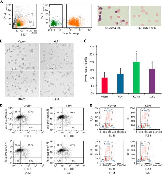 KLF1-GATA1 fusion protein reduces hypoxia-related sickling in erythroid cells cultured from CD34+ cells isolated from blood samples of patients with SCD. (A) CD34+ cells isolated from patients with SCD were lentivirus-transduced with vector only, KLF1, or KLF1-GATA1 fusion protein, then grown in a 3-phase erythroid culture system.39 (A) At day 19, cultured erythroid cells were stained with TO for sorting enucleated erythroid cells. Unsorted or TO− sorted cells (enucleated erythroid cells) were cytospun, followed by Giemsa staining. (B) Representative bright-field images of enucleated erythroid cells that were incubated for another 16 hours in a 2% oxygen environment in culture medium before image processing. All images were taken within 3 minutes after removal from 2% oxygen without further manipulating the cells. Original magnification ×35. (C) Mean percentage of nonsickled (round) erythroid cells after a 16-hour incubation in a 2% oxygen environment. ∗P < .05 vs vector control-transduced cells. Error bars indicate the mean ± SD results of 3 independent experiments. (D) Flow cytometry analysis of cultured erythroid cells for erythroid differentiation markers glycophorin A and transferrin receptor (CD71). At least 3 independent experiments were performed. (E) Bromodeoxyuridine incorporation assay of cultured erythroid cells for cell proliferation. R2, R3, and R4 represent the G1, S, and G2 phases, respectively. At least 3 independent experiments were performed. KG-M, KLF1-GATA1 medium form; KG-L, KLF1-GATA1 long form.