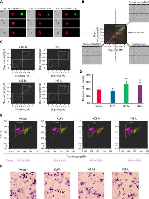 KLF1-GATA1 fusion protein reduces hypoxia-related sickling in erythroid cells cultured from SCD mouse HSCs. Sca-1+c-Kit+Lin/low HSCs isolated from SCD mice were transduced with vector only, KLF1, or KLF1-GATA1 fusion protein, then grown in a 3-phase erythroid culture system. (A–D) SIFCA of cultured erythroid cells stained with TER119-APC antibody and TO. (A) Bright-field and fluorescence images of erythroid cells acquired by imaging flow cytometry, illustrating examples of the cell morphologies. (B) SIFCA identifying the shape ratio cutoff of 0.5 used for classifying cultured erythroid cells as normal/round, abnormal/sickled, or undefined/indeterminate, and associated representative bright-field imagery. Shape ratio is the minimum width of the cell divided by the maximum length identified by the analysis software. Cells with a shape ratio lower than the cutoff values were designated as “abnormal cells (sickled cells).” Cells with a shape ratio higher than the cutoff level were defined as “normal cells (non-sickled cells).” Cells were designated as “undefined” if the cells could not be categorized.87,88 (C) Representative SIFCA of cultured erythroid cells. (D) Graphic representation showing the mean percentage of normal cells identified through SIFCA. ∗∗P < .01 vs vector control–transduced cells. Error bars indicate the mean ± SD of 3 independent experiments. (E) Representative flow-cytometric analysis of cultured erythroid cells stained with TER119-APC antibody and TO to assess erythroid enucleation. Data represent the mean ± SD of 3 independent experiments. (F) Giemsa staining of cultured erythroid cells. Original magnification, ×40. All analyses were performed at the time points indicated in Figure 4B. KG-M, KLF1-GATA1 medium-form; KG-L, KLF1-GATA1 long-form; SIFCA, sickle cell imaging flow cytometry assay.
