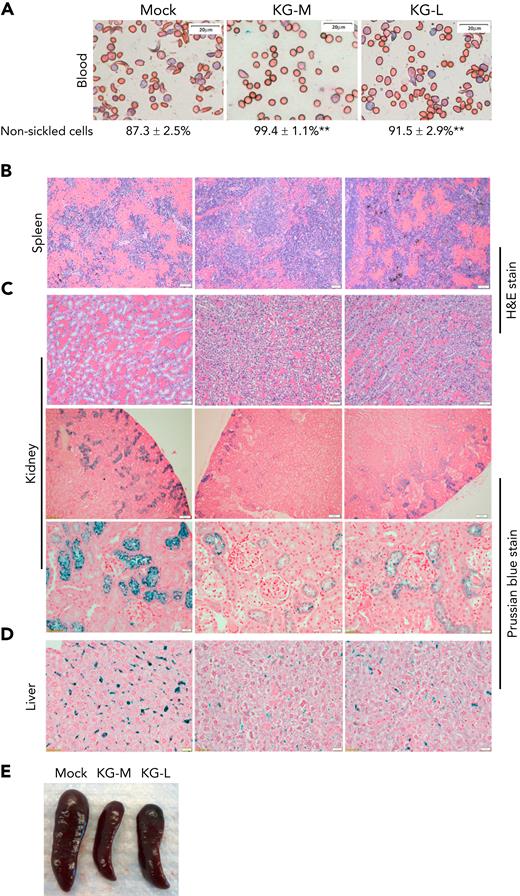 Transplantation of KLF1-GATA1–expressing SCD mouse HSCs into SCD mice reduces the percent of sickling cells in peripheral blood and improves SCD-related pathologic changes in spleen, kidney, and liver. Mock- or KLF1-GATA1–transduced SCD mouse HSCs were transplanted into SCD mice. Recipient mice were euthanized 20 to 24 weeks after transplantation, and peripheral blood and tissues were collected. Tissue sections were stained to evaluate organ pathology and iron accumulation. (A) Representative Giemsa staining of peripheral blood smear for evaluating erythrocyte morphology. Bar represents 20 μm. Images were acquired with an Olympus BX51 microscope (Olympus, Center Valley, PA) and a Qimaging Camera with Q Capture pro software (Qimaging, Surrey, BC, Canada). Four random fields were imaged from each sample, and cellular morphologies were scored by blinded observers. ∗∗P < .01 vs vector control–transduced cells. Error bars indicate the mean ± SD results of 3 independent experiments. (B) Representative spleen tissue stained with hematoxylin and eosin (H&E). Bars represent 50 μm. (C) Top row: representative kidney tissue stained with H&E. Bar represents 50 μm. Middle and bottom rows: representative kidney tissue stained with Prussian blue for iron content. Bar represents 100 μm (middle) and 20 μm (bottom). (D) Representative liver sections stained with Prussian blue for iron content. Bar represents 50 μm. (E) Representative spleens collected from recipient mice. Mock mice are SCD mice with mock-transduced SCD mouse HSC transplants; KG-M and KG-L mice are SCD mice that receive transplants of medium- and long-form KLF1-GATA1–transduced SCD mouse HSCs, respectively.