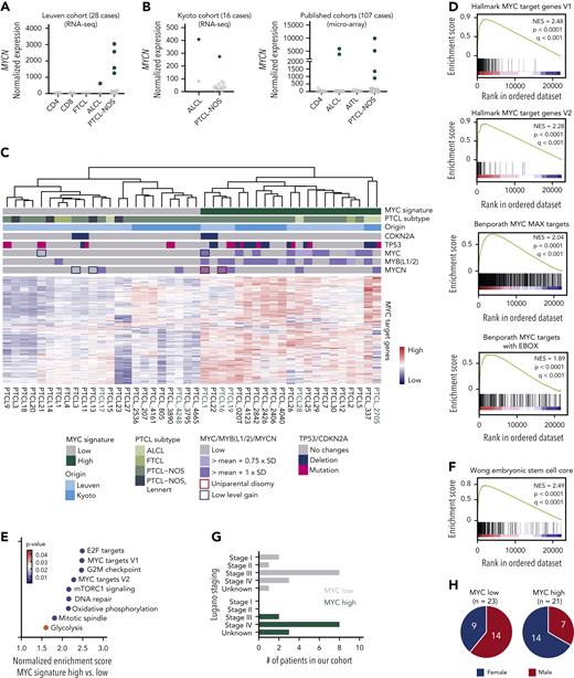 MYCN is aberrantly overexpressed in PTCL. (A) Normalized counts for MYCN in the Leuven PTCL cohort of 28 cases. (B) Normalized counts for MYCN in three published data sets (RNA-seq24 and microarray22,23). AITL, angioimmunoblastic T-cell lymphoma. (C) Heat map showing expression of MYC target genes from the hallmark gene sets in PTCL cases from the Leuven and Kyoto cohorts. Samples indicated in green harbor overexpression of MYCN. (D) Gene set enrichment analysis (GSEA) showing enrichment of different MYC target gene sets in the differentially expressed genes of PTCL with a high MYC signature compared with PTCL with a low MYC signature. NES, normalized enrichment score. (E) Normalized enrichment scores for different hallmark gene sets in MYC high vs low PTCL. (F) GSEA showing enrichment of an embryonic stem-cell-like signature as described by Wong et al.25 (G) Lugano staging for the patients with PTCL in the Leuven cohort. (H) Pie chart representing the sex of the patients with PTCL in the MYC low (left) and MYC high (right) subgroups. The difference between the female presence in the 2 groups was calculated using a hypergeometrical distribution (P = .016). See also supplemental Figure 1.