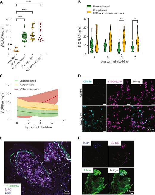 S100A8/A9 accelerates the recruitment of annexin-V–positive platelets and fibrin generation at a venous shear rate. (A-C) Plasma levels of S100A8/A9 were measured by ELISA in healthy donors and patients with uncomplicated and complicated (ICU survivors/nonsurvivors) COVID-19 over 7 consecutive days after inclusion in the study. (A) S100A8/A9 levels in the plasma of healthy donors (control, n = 10), uncomplicated COVID-19 patients (n = 48), ICU survivors (n = 26), and ICU nonsurvivors (n = 13) on the first day of patient inclusion in the study. (B-C) S100A8/A9 levels in the plasma over 7 consecutive days after patient recruitment. (D-G) Representative immunofluorescence staining of lung autopsies obtained from COVID-19 patients or age-matched control. Images were captured using Epi fluorescence microscope and slide scanner Axioscan Z1. (D) Platelet CD42b and heterodimeric S100A8/A9 staining in lung parenchyma and microcirculation in COVID-19 and control lung autopsies. (E) Staining for S100A8/A9, MPO, and nuclei (DAPI) of a large vessel in the lung of a patient with COVID-19 with thrombotic complications. (F) Staining for platelet CD42b, fibrin, and nuclei (DAPI) in large thrombi of a patient with COVID-19. (G) S100A9, CD42b, and fibrin staining in COVID-19 lung. Arrow shows platelet-fibrin microaggregates. (H) Whole blood under recalcified conditions was perfused at a venous shear rate (100 s−1) over S100A8/A9 (40 μg/mL), collagen (100 μg/mL), or combination of S100A8/A9 and collagen-coated chambers. The presence of PS-positive platelets and fibrin were assessed using annexin-V-Alexa Fluor-647 and FITC-anti-fibrinogen/fibrin antibody, respectively. (H) Representative images taken at 15 minutes. (I) Quantification of annexin-V signal (3 minutes) (n = 5) and (J) fibrin signal time course (0-15 minutes) (n = 5) using predefined semiautomated scripts in Fiji as detailed in the supplemental Methods (available on the Blood website). Results are shown as mean ± standard error of the mean (SEM). The statistical significance was analyzed using two-way ANOVA with Tukey’s multiple comparison test between all groups. ∗P < .05, ∗∗P < .005, ∗∗∗P < .001, ∗∗∗∗P < .0001.