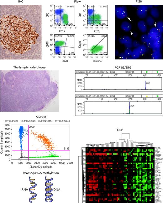 The lymph node biopsy. A variety of methodologies play a role in the contemporary diagnosis of lymphoma. These include immunohistochemistry (IHC); flow cytometry (Flow); fluorescence in situ hybridization for genomic rearrangements (FISH); PCR for immunoglobulin and T-cell receptor gene rearrangements (PCR IG/TRG); PCR for targeted single cell mutations (eg, MYD88); high-throughput sequencing methods for analysis of RNA and DNA (RNAseq/NGS Methylation); and gene expression profiling (GEP). Karyotyping performed on metaphase spreads is still valuable in some settings.