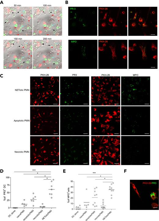 (A) NETs persistently interact with mDCs. In this live imaging experiment, agar-PMNs were seeded onto culture dishes and allowed to adhere 30 minutes before adding mDCs previously labeled with the membrane vital dye PKH-26. The cocultures were also performed in the presence of the DNA dye SYTOX green, which stains only PMNs undergoing NETosis. The coculture was maintained o/n in a humidified chamber under confocal microscope, acquiring a picture every 10 minutes to highlight any interaction between PMNs and mDCs. PMNs in the cellular mixture form NETs (turquoise arrows) and NETs interact with mDCs (red arrows). Black arrows indicate naive neutrophils. (B) Uploading of mDCs with NET components. After NET interaction, mDCs are uploaded with the neutrophil protein PR3 and MPO. In this live imaging experiment, labeled PKH-26 mDCs were added to agar-PMN in the presence of a mAb to PR3 or MPO directly conjugated with Alexa-488 dye. After 18 hours, cells were fixed with PFA 4% and observed under a confocal microscope. Scale bars represent 10 μm. One representative experiment of 5 performed. (C) Uploading of PR3 and MPO by mDCs tested in the presence of different type of PMN death. Apoptotic PMNs, generated by Fas triggering Ab and necrotic PMNs obtained by freeze and thaw, were compared with NETotic PMNs for their capability to transfer PR3 and MPO to mDCs in coculture experiments. Representative confocal IF analysis showing that necrotic PMNs almost failed to transfer neutrophil PR3 or MPO to mDCs; on the contrary, PR3 and MPO were detectable as dotted green fluorescence in mDCs that interacted with NETotic PMNs and, to a lesser extent, in mDCs cultured with apoptotic PMNs. (D-E) Software-assisted micrograph quantification of mDCs uploading of PR3 (D) and MPO (E) performed on a total of 200 cells that were imaged by confocal microscopy. DCs cultured with naive PMNs, maintained alive by incubating them in the presence of 30% of FCS and DCs alone, were the negative controls for PR3 transfer and MPO. (F) Appearance of PR3+ apoptotic bodies that are taken up by mDCs cocultured with apoptotic cells. The scale bar represents 30 μm.