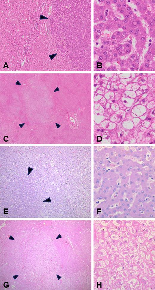 Histopathologic (H&E stain) assessment of canine livers at postmortem in AAV-treated dogs (A-D) and an untreated control (E-H). Foci of hepatocyte nodular hyperplasia (A-B and E-F) characterized by nonencapsulated areas of hepatocyte proliferation (A,E: magnification ×50) with mildly thickened liver cell plates (B,F: magnification ×400). Also observed were ill-defined regions of liver parenchyma pallor due to hepatocyte cytoplasmic clearing (C: magnification ×15; G: magnification ×25), characteristic of canine vacuolar hepatopathy (D,H: magnification ×400).