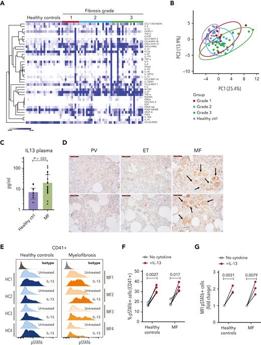 The IL-13 signaling pathway is activated in patients with MF. (A) Heat map of cytokines detected in the plasma of healthy controls and patients with MF (grouped by fibrosis degree). N = 11 to 20 samples per group. (B) Principal component analysis of samples shown in panel A. (C) Levels of IL-13 in plasma samples from healthy controls or patients with MF were not grouped based on fibrosis degree. P value was derived using the Mann-Whitney test with Benjamini, Krieger, and Yekutieli corrections. Data represent the average ± SEM. (D) Immunohistochemistry for IL-13Rα1 in human BM biopsies from patients with polycythemia vera, essential thrombocythemia, or MF. Scale bar, 50 μm. Black arrows indicate megakaryocytes with high IL-13Rα1 expression of the MF samples. Each image represents a different sample. (E) Representative flow cytometry plot of STAT6 phosphorylation in response to IL-13 stimulation in human megakaryocytes derived from healthy controls or patients with MF measured by flow cytometry. (F) Percentage of pSTAT6-positive cells gated on megakaryocytes CD41+. (G) Mean fluorescence intensity of pSTAT6-positive CD41+ cells. Paired Student t test was used for statistical analysis. ctrl, control; EGF, endothelial growth factor; ET, essential thrombocythemia; FGF2, fibroblast growth factor 2; HC, healthy control; MFI, mean fluorescence intensity; PDGF, platelet-derived growth factor; PV, polycythemia vera.