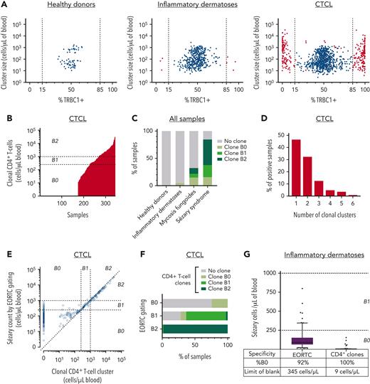 Semiautomated detection of constant beta chain–restricted CD4+ T-cell clusters rapidly identifies Sézary cells, with improved specificity over traditional gating strategies. (A) Blood samples from healthy donors (left), patients with benign inflammatory dermatoses (middle), and patients with CTCL (right) were analyzed by flow cytometry using automated clustering and calculation of percentage TRBC1-positive events per cluster. Individual CD4+ T-cell clusters (dots) were classified as clonal (red) or nonclonal (blue) based on pre-established clonality thresholds (dotted lines) or monophasic TRBC1-dim expression on visual analysis. (B) Absolute numbers of Sézary cells (clonal CD4+ T cells) per microliter in patients with CTCL. (C) Results of blood ratings based on total clonal CD4+ T cells. (D) Number of clonal CD4+ T-cell clusters identified per sample on patients with CTLC. (E) Absolute numbers of Sézary cells estimated by clustering and TRBC1 expression compared to the gating strategy recommended by the EORTC. (F) Blood ratings estimated by the EORTC-recommended gating strategy compared to automated clustering and TRBC1 expression. (G) Diagnostic specificity for B1-B2 blood rating (%B0) and analytical specificity (limit of blank) of the EORTC-recommended gating strategy (left) compared to automated clustering and TRBC1 staining (right); based on patients with inflammatory dermatoses.
