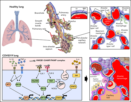 Inflammatory response to inhalation of COVID-19 in the pulmonary vasculature. Healthy lung: Depicted is a healthy lung (left) and a bronchiole (center) within the lung emphasizing the vasculature and alveolar sacs. A schematic of a histological cross section through an alveolar-capillary unit showing alveolar air sacs (white) lined by alveolar type 1 cells (purple) and separated from capillaries by a basement membrane (blue). The alveolar sac is studded with alveolar type 2 cells (yellow) and alveolar macrophages (green). The inset highlights the air-blood interface that is separated by the alveolar type 1 cell, basement membrane, and the capillary, from top to bottom. COVID lung: The left panel depicts inflammatory signaling through cytokine receptors (IL-1βR, TNFR, and IL-6R) and receptors of innate immunity (TLRs and NOD2) following SARS-CoV-2 infection. The right panel demonstrates sequelae of SARS-CoV-2 infection at the level of the alveolus. Deposition of debris and inflammatory products results in the formation of a hyaline membrane that lines the alveolar sac and impairs exchange (dark pink). Expression of leukocyte receptors results in monocytic infiltrates (purple) and neutrophil extravasation (light pink). Proliferation of alveolar type 2 cells is observed (yellow). Loss of barrier function results in capillary leak (tan). Loss of vascular integrity results in alveolar hemorrhage (red). Microvascular occlusion (red brown) and extravascular fibrin formation (brown) occur. Endothelial swelling and sluffing ensues. TLRs, toll-like receptors; TNFR, tumor necrosis factor receptor.