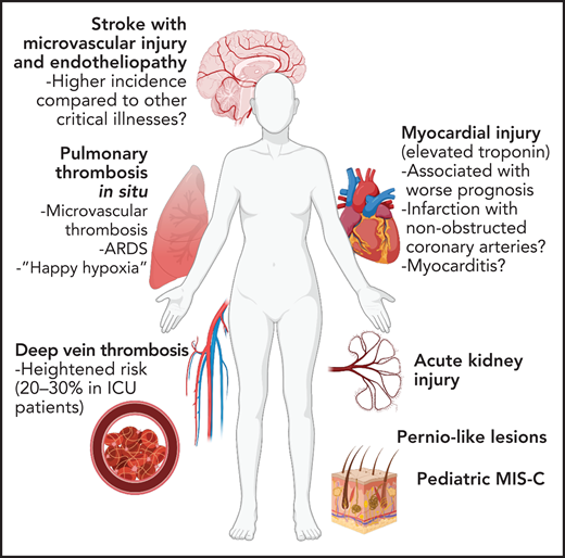 Vascular complications of COVID-19. Due to widespread endothelial dysfunction and thrombosis, COVID-19 has the ability to affect nearly any organ. Pulmonary disease, specifically ARDS, may be driven in large part by vascular dysfunction and microvascular thrombosis. Increased thrombotic events, most notably venous thromboembolism but also myocardial infarction and stroke, have been reported. Vascular dysfunction may contribute neurologic, renal, and dermatologic manifestations of COVID-19, as well as post-COVID sequelae such as multisystem inflammatory syndrome in children (MIS-C).