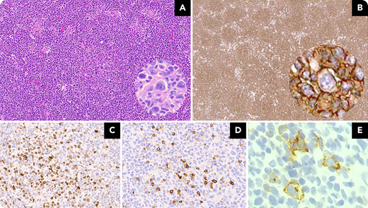A 74-year-old man presented with recurrent respiratory infections without B symptoms, with mediastinal and supraclavicular lymphadenopathy on chest computed tomography. A fine-needle biopsy of a supraclavicular lymph node revealed distorted architecture with vaguely nodular growth, predominantly composed of medium-large cells with centroblastic morphology, rare centrocytes, and abundant mitotic activity (panel A; 10× objective, ×100 original magnification). Also identified were scattered, large, binucleated Reed-Sternberg–like and variant-like cells (panel A, inset; 40× objective, ×400 original magnification). The neoplastic population, including the Hodgkin-like cells, was CD20+ (panel B; 4× objective, ×40 original magnification; inset, 40× objective, ×400 original magnification); PAX5+, MUM1+, p53+, and bcl2+; weakly bcl6+ (panel C; 10× objective, ×100 original magnification); and CD10+ (panel D; 10× objective, ×100 original magnification), with >50% c-myc expression in the centroblastic cells. The Hodgkin-like cells were CD30+ (panel E; 40× objective, ×400 original magnification). Ki-67 showed a proliferative index of 60% to 70%; CD23 highlighted the dendritic meshwork. Flow cytometry revealed a CD19+/CD20+/CD5(partial) population with κ-chain restriction. Molecular testing showed 3 clinically significant variants: CREBBP, KMT2D/MLL2, and TNFAIP3. No abnormalities were detected in BCL2, and no translocations were identified. Reed-Sternberg–like cells have been described in cases of follicular lymphoma, independent of grade, and they have been shown to be clonally related to the follicular lymphoma cell population. The importance of these cells lies in the diagnostic challenge they create and possibly in providing early evidence of transformation.