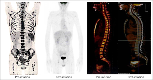 Representative PET-CT images of patient 12 before and after NS7CAR T-cell infusion. (Left) As shown in the PET-CT, the patient had diffuse extramedullary lesions before NS7CAR T-cells infusion. (Right) The patient achieved an extramedullary complete remission on day 51 after infusion.