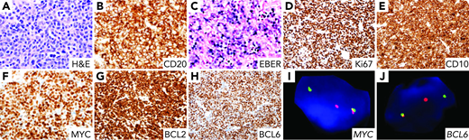 A 90-year-old man with no history of lymphoma presented with a right base of tongue mass and ipsilateral lymphadenopathy. Blood counts were normal except for mild anemia (hemoglobin 12.9 g/dL). A right submandibular lymph node biopsy revealed nodal architectural effacement by sheets of large centroblastic and immunoblastic cells (panel A; original magnification ×600). Neoplastic cells were diffusely positive for CD20 (panel B; original magnification ×400) and Epstein-Barr virus (EBV)-encoded RNA (77% of cells; panel C; original magnification ×400), with Ki-67 labeling index approaching 100% (panel D; original magnification ×200). They were diffusely positive for CD10 (panel E; original magnification ×200), MYC (panel F; original magnification ×400), BCL2 (panel G; original magnification ×200), and BCL6 (panel H; original magnification ×200), but negative for CD5, BCL1, LMP1, and EBNA2 (type 1 latency). Fluorescence in situ hybridization detected MYC rearrangement (32%; panel I), MYC gain (18%), and BCL6 rearrangement (76%; panel J). Next-generation sequencing revealed pathogenic point mutations in BCL2 (c.585 + 7G>A;p.P59A;p.H3Q;p.K17N suggestive of somatic hypermutation), CREBBP, FBXW7, and ID3. There was no evidence of structural variants in BCL2, although a cryptic BCL2 translocation could not be entirely excluded.