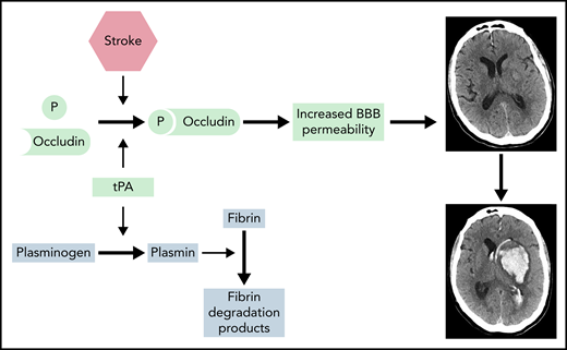 tPA has a therapeutic role in AIS, but it leads to a significant rate of ICH. Administration of rtPA accelerates the conversion of plasminogen to plasmin, which in turn lyses fibrin to its degradation products. At the same time, tPA induces phosphorylation (P) of occludin, which increases BBB permeability. AIS also upregulates occludin phosphorylation and BBB permeability. Both pathways of occludin phosphorylation and increased BBB permeability increase the risk of ICH in patients presenting with AIS.