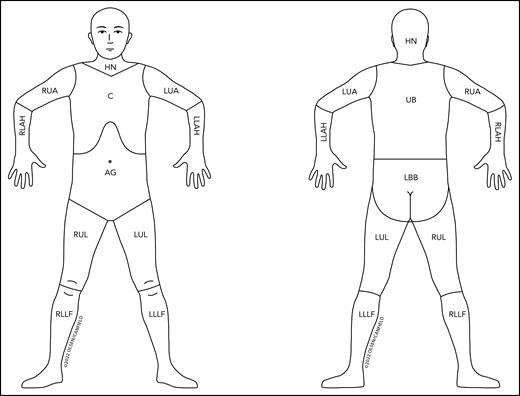 Revised nodal drainage areas for determination of classification of skin involvement in non-MF/non-SS PCLs. The nodal regions (based on the Ann Arbor classification)31 and their boundaries are as follows: head and neck (HN), inferior borders = clavicles anterior and T1 spinous process posterior; left upper arm (LUA), superior border = glenohumeral joint (exclusive of axilla), inferior border = ulnar/radial/humeral (elbow) joint; left lower arm and hand (LLAH), superior border = ulnar/radial/humeral (elbow) joint; right upper arm (RUA), superior border = glenohumeral joint (exclusive of axilla), inferior border = ulnar/radial/humeral (elbow) joint; right lower arm and hand (RLAH), superior border = ulnar/radial/humeral (elbow) joint; chest (C), superior border = superior border clavicles, inferior border = inferior margin rib cage, lateral borders = midaxillary lines and glenohumeral joints (inclusive of axilla); abdomen/genital (AG), superior border = inferior margin rib cage, inferior border = inguinal folds and anterior perineum; upper back (UB), superior border = T1 spinous process, inferior border = inferior margin rib cage, lateral borders = midaxillary lines; lower back/buttocks (LBB), superior border = inferior margin rib cage, inferior border = inferior gluteal fold and anterior perineum (inclusive of perineum), lateral borders = midaxillary lines; left upper leg (LUL), superior border = inguinal fold and gluteal folds, inferior border = midpatella anterior and mid–popliteal fossa posterior; left lower leg and foot (LLLF), superior border = midpatella anterior and mid–popliteal fossa posterior; right upper leg (RUL), superior border = inguinal fold and gluteal folds, inferior border = midpatella anterior and mid–popliteal fossa posterior; right lower leg and foot (RLLF), superior border = midpatella anterior and mid–popliteal fossa posterior.