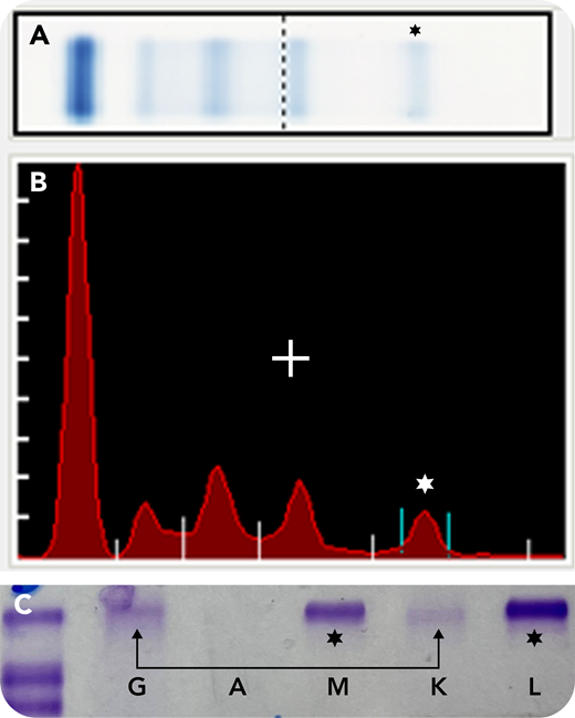 Serum protein electrophoresis/immunofixation electrophoresis (SPEP/IFE) was performed on a 63-year-old woman with a history of Waldenstrom macroglobulinemia, on ibrutinib, and identified the known monoclonal immunoglobulin M λ paraprotein (*, panels A-C), at 0.3 g/dL. In addition, a faint cathodal immunoglobulin G (IgG) κ monoclonal protein was identified (↔, panel C) by IFE. At the time, the patient was admitted to the hospital with acute hypoxemic respiratory failure and was subsequently diagnosed with persistent acute COVID-19 infection. Two months before admission, she developed a cough and sore throat, tested positive for COVID-19, and received sotrovimab, an IgG κ COVID-19 monoclonal antibody (MAb) therapy. Given the patient’s history of Waldenstrom macroglobulinemia, SPEP/IFE was sent during admission, to exclude hyperviscosity as a contributor to the patient’s dyspnea. The faint IgG κ monoclonal band was interpreted as evidence of the patient’s prior COVID-19 MAb therapy. The patient was discharged 1 month after admission, in stable condition, on 1 L of oxygen and a prednisone taper.