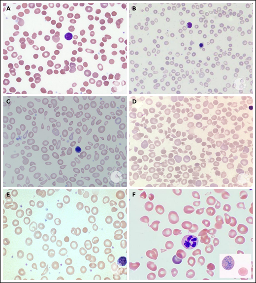 PB smears. PB smears from (A) hereditary spherocytosis. Dense, spherical-shaped erythrocytes are seen. (B) β-Thalassemia major. Hypochromic, microcytic erythrocytes, anisocytosis, and a nucleated red blood cell are seen. (C) Sideroblastic anemia. Polychromasia, anisopoikilocytosis, and basophilic stippling are seen in a case of X-linked congenital sideroblastic anemia. (D) Thrombotic thrombocytopenic purpura. Anisopoikilocytosis and marked schistocytosis are seen on the smear of an infant with Upshaw-Schulman syndrome. (E) Iron deficiency. Significant anisocytosis, hypochromia, and microcytosis are seen. (F) Vitamin B12 deficiency. Macro-ovalocytes, microcytes, and hypersegmented neutrophils are seen. Erythrocyte basophilic stippling is shown in inset. These images were originally published in the ASH Image Bank. (A) Teresa Scordino, Hereditary spherocytosis, 2016, #00060308. (B) Girish Venkataraman, β-thalassemia major, 2018, #00062081; (C) Katherine Calvo, Congenital sideroblastic anemia peripheral blood, 2015; #00060064; (D) Helle Borgstrøm Hager and Mari Tjernsmo Andersen, Thrombotic thrombocytopenic purpura, #00061402; (E) Iron deficiency anemia moderate, 2015, #00060219. (F) Volodymyr Shponka and Maria Proytcheva, Megaloblastic anemia caused by severe B12 deficiency in a breastfed infant. 2017, #00061082. © The American Society of Hematology.