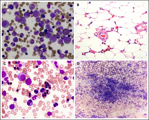BM examination. (A) Diamond-Blackfan anemia. BM aspirate shows a marked myeloid predominance. (B) Acquired aplastic anemia. High-power image of a hematoxylin and eosin-stained BM biopsy section from a teenage girl showing profound hypocellularity. The few remaining hematopoietic cells are lymphocytes, plasma cells, and macrophages with pigment in their cytoplasm. (C) Congenital dyserythropoietic anemia (CDA) type II. BM aspirate shows binucleated and multinucleated erythroid precursors. (D) Neuroblastoma. BM biopsy shows clumps of metastatic neuroblastoma cells. These images were originally published in the ASH Image Bank. (A) Amy Duffield, Diamond Blackfan Anemia Aspirate, 2015, #00060078. (B) Kristian T. Schafernak, Acquired Aplastic Anemia, 2016, #00060876. (C) Kristian T. Schafernak, Congenital Dyserythropoietic Anemia, Type II, 2016, #00060891. (D) Suzanne Vercauteren. Neuroblastoma Bone Marrow, 2015, #00060131. © The American Society of Hematology.
