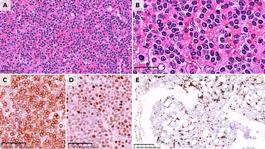 A 74-year-old man presented with a B-cell lymphoproliferative disorder involving bone marrow with marked splenomegaly. Splenectomy was performed (weight, 9400 g) showing diffuse beefy-red appearance with no mass lesions. Histologic sections showed diffuse infiltration of the red pulp (panel A, ×600 original magnification) by a monomorphic population of small- to medium-sized lymphoid cells with round nuclei, mature chromatin, and small nucleoli (panel B, ×800 original magnification). The neoplastic lymphoid cells were positive for CD20, CD79a (panel C, ×400 original magnification), DBA44, and cyclin D3 (panel D, ×400 original magnification) but negative for CD5, cyclin D1, IgD, annexin A1, and LEF1 by immunohistochemistry. Bone marrow showed intrasinusoidal involvement highlighted by CD20 staining (panel E, ×100 original magnification).