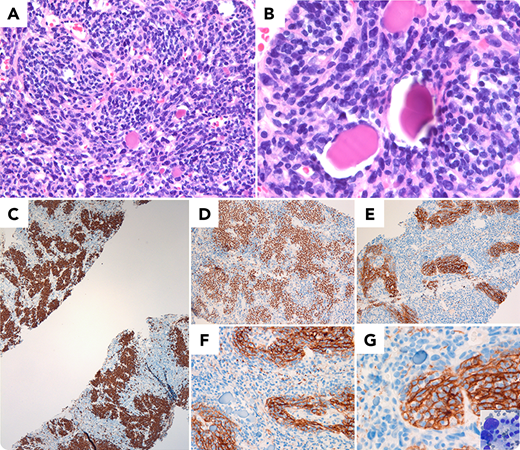 A 52-year-old female presented with an isolated anterior 10-cm mediastinal mass with a normal complete blood count. A core biopsy of the mass revealed a vaguely compartmentalized mononuclear infiltrate (panel A, hematoxylin and eosin) with lymphoid cytomorphology demonstrating occasional streaming. The constituent lymphoid cells were small- to medium-sized (panel B, hematoxylin and eosin) with scattered hyaline globules. Initial workup to exclude lymphoma and thymoma revealed numerous serpiginous clusters of B cells (panel C and D, CD20 immunohistochemistry) with negative CD5, CD10, BCL6, and keratin without evidence of B-cell clonality by polymerase chain reaction. Further workup revealed numerous cells within the nodules positive for follicular dendritic cell (FDC) markers CD21 (panel E, PAX5; panel F, CD21) and CD35 (panel G) with scattered large, atypical cells on Wright-Giemsa stain (panel G, inset), supporting designation as follicular dendritic cell tumor. The diagnosis was confirmed in a subsequent excision of the mass.