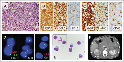 Burkitt-like variant of HGBL, NOS. (A) High magnification of hematoxylin and eosin stain shows a starry-sky pattern with a diffuse infiltrate of medium to large cells with finely dispersed chromatin, several small nucleoli, and frequent mitoses. (B) Malignant B cells express the germinal center markers CD10 and BCL6 but are largely negative for BCL2. (C) Ki-67 proliferation index was ∼100%, and neoplastic cells showed high expression of MYC but were CD43−; other negative markers included BCL1, TdT, MUM1, and EBER by in situ hybridization. (D) FISH shows no evidence of MYC-R or BCL2-IGH rearrangement (FISH probes: Vysis LSI IGH/MYC/CEP 8 Tri-Color Dual Fusion Probe, Vysis LSI MYC-Dual Color Break-Apart Probe, and Vysis LSI IGH/BCL2 Dual Color Dual Fusion Probe; Abbott Molecular). (E) Cerebrospinal fluid cytology shows medium to large cells with round to irregular nuclear contours, variably prominent nucleoli, and moderate amount of cytoplasm. (F) The patient, a 43-year-old HIV− man, presented with extensive abdominal adenopathy and infiltration of the CNS, gastrointestinal tract, bilateral kidneys, and adrenal glands on computed tomography scan; he attained a complete response (CR) to the R-CODOX-M/IVAC (rituximab plus cyclophosphamide, doxorubicin, vincristine, and high-dose methotrexate alternating with ifosfamide, cytarabine, and etoposide) regimen with intrathecal therapy and remains in remission 1 year later. Original magnification: ×600 (A), ×400 (B-C), and ×1000 (E).