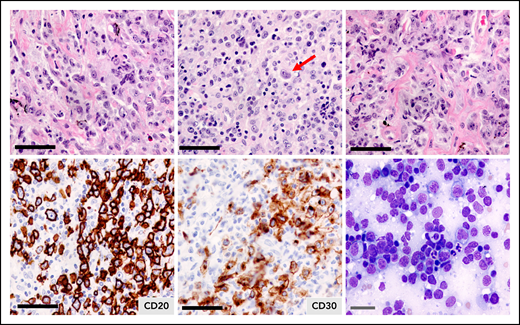 Primary mediastinal large B-cell lymphoma. Hematoxylin and eosin staining illustrating the clear cytoplasm of the neoplastic cells and the fibrotic bands without annular distribution that compartmentalize the tumor cells. Tumor cells express CD20 and most express CD30, which is weak and heterogeneous. The arrow depicts a multilobulated Hodgkin Reed Sternberg-like cell. Black bars = 50 μm; gray bar = 20 μm.