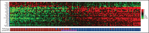 Heat map of gene expression comparing PMBCL and DLBCL. Each column represents a case, and the discriminating gene features included in Lymph3Cx assay are in rows. The top 6 genes are overexpressed in DLBCL, and the remaining 24 genes show higher expression in PMBCL. Modified from Mottok et al.25
