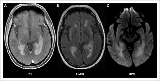 PCNSL imaging pattern on MRI. Characteristic PCNSL imaging features on MRI. (A) T1 sequence with gadolinium contrast (T1c) demonstrates homogenously enhancing lesions affecting the deep white matter. (B) Fluid-attenuated inversion recovery (FLAIR) sequence demonstrates moderate edema surrounding the lesion. (C) Diffusion-weighted imaging sequence (DWI) demonstrates restricted diffusion within the lesions.
