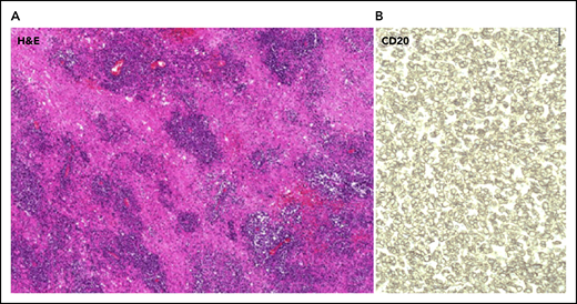 Effects of corticosteroids on imaging in PCNSL and histopathologic features of PCNSL. (A) Hematoxylin and eosin (H&E) staining (10× magnification) of PCNSL demonstrating angiocentric growth pattern and diffusely infiltrating PCNSL cells invading the brain parenchyma. (B) Cells are positive for the B-cell surface marker CD20 (40× magnification).