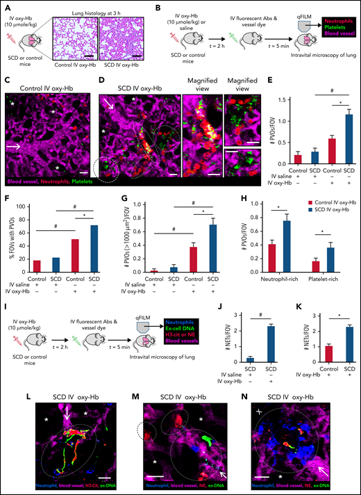 NETs promote lung vaso-occlusion in mice with SCD in vivo. (A) Lung histology (Hematoxylin and Eosin staining; 10× magnification) of control mice and mice with SCD, 3 hours after IV administration of 10 µmol/kg oxy-Hb. Refer to supplemental Figure 1 for larger FOVs and lung injury quantification. (B) Experimental scheme used in panels C to H: Control mice and mice with SCD were IV administered 10 µmol/kg oxy-Hb or saline, and qFILM was used to assess the absence or presence of platelet-neutrophil aggregate mediated pulmonary vaso-occlusion (PVO). Pulmonary microcirculation (pseudo-colored purple), neutrophils (red), and platelets (pseudo-colored green) were labeled in vivo by IV administration of fluorescein isothiocyanate (FITC) dextran, AF546-anti-Ly6G Ab, and V450-anti-CD49b Ab, respectively. Representative qFILM images are shown in panels C to D. (C) IV oxy-Hb led to minimal lung vaso-occlusion in a control mouse. (D) IV oxy-Hb led to occlusion of arteriolar bottlenecks in the lung of a mouse with SCD by large neutrophil-platelet aggregates (marked by dotted white ellipse). Magnified cropped images of the individual neutrophil-platelet aggregates are shown on the right. Colocalization of neutrophils (red) with platelet (green) appears yellow. (E-H) PVOs were quantified using strategy described in supplemental Methods. IV oxy-Hb led to significantly more (E) PVOs per FOV, (F) percent FOVs with PVOs, (G) large PVOs (with area >1000 µm2) per FOV, and (H) both neutrophil-rich and platelet-rich PVOs per FOV, in mice with SCD compared with control mice. Control IV saline (n = 3 mice; 38 FOVs), SCD IV saline (n = 4 mice; 49 FOVs), control IV oxy-Hb (n = 5 mice; 71 FOVs), SCD IV oxy-Hb (n = 5 mice; 75 FOVs). (I) Experimental scheme used in panels J to N: Control mice and mice with SCD were IV administered 10 µmol/kg oxy-Hb, and qFILM was used to assess the absence or presence of NETs within the pulmonary microcirculation. Pulmonary microcirculation (pseudo-colored purple), neutrophils (blue), extracellular DNA (green), and citrullinated histones (H3-Cit; red) or NE (red) were labeled in vivo by IV administration of Evans blue, Pacific blue–anti-Ly6G Ab, Sytox green, and AF546–anti-H3-Cit Ab or AF546–anti-NE Ab, respectively. (J-K) NETs were quantified as described in supplemental Methods. Number of NETs per FOV (#NETs/FOV) was significantly higher in mice with SCD administered IV oxy-Hb (n = 4 mice; 44 FOVs) than (J) mice with SCD administered IV saline (n = 4 mice; 49 FOVs) or (K) control mice administered IV oxy-Hb (n = 4 mice; 43 FOVs). Representative qFILM images (L-N) reveal NETs (marked by dotted white ellipse) in the pulmonary arteriole bottlenecks of mice with SCD administered IV Oxy-Hb. NETs were identified based on colocalization of Ly6G (blue) with exDNA (green) and (L) H3-cit (red) or (M,N) NE (red). “X” (in panel N) denotes loss of blood flow (purple dye absent) downstream of NETs-associated lung vaso-occlusion (marked by white ellipse). White arrows denote the direction of blood flow within the pulmonary arterioles. Alveoli are marked with white asterisks. Scale bars, 200 µm, in panel A and 20 µm in panels C-D, L-N. qFILM FOV size ∼65 536 µm2. *P < .05 for SCD compared with control. #P < .05 for IV oxy-Hb compared with IV saline. Means in panels E,G compared using Student t test with Bonferroni correction. Percentages in panel F compared using fourfold table analyses with Bonferroni χ2 statistics. Means in panels H, J-K compared using Student t test. Data in panels E, G, H, J, and K represent mean ± standard error (SE). The diameter of pulmonary arteriole in panels C, D, L, M, and N is ∼28 µm, 26 µm, 14 µm, 14 µm, and 28 µm, respectively.